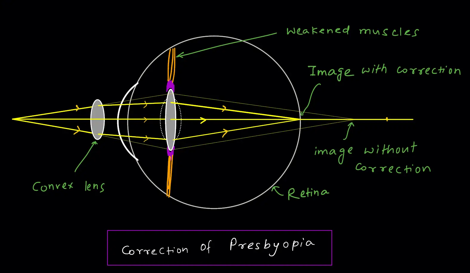 defects of vision - correction of presbyopia