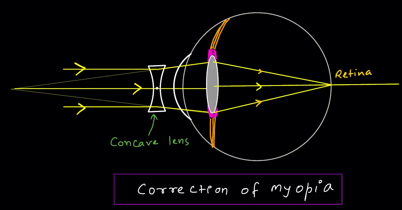 defects of vision - correction of myopia