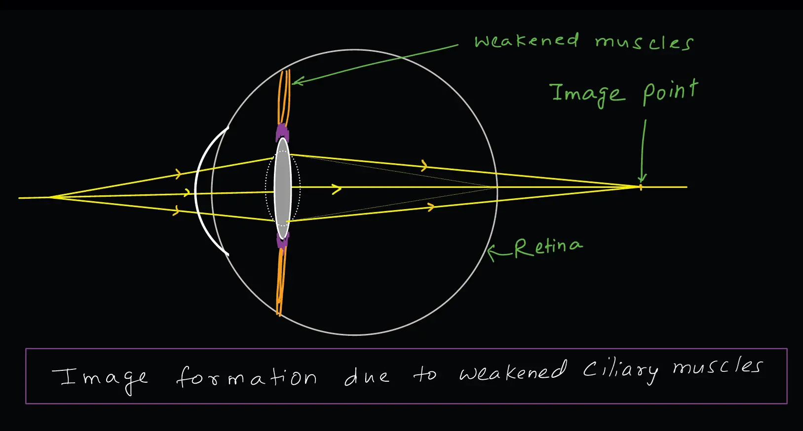 defects of vision - Presbyopia