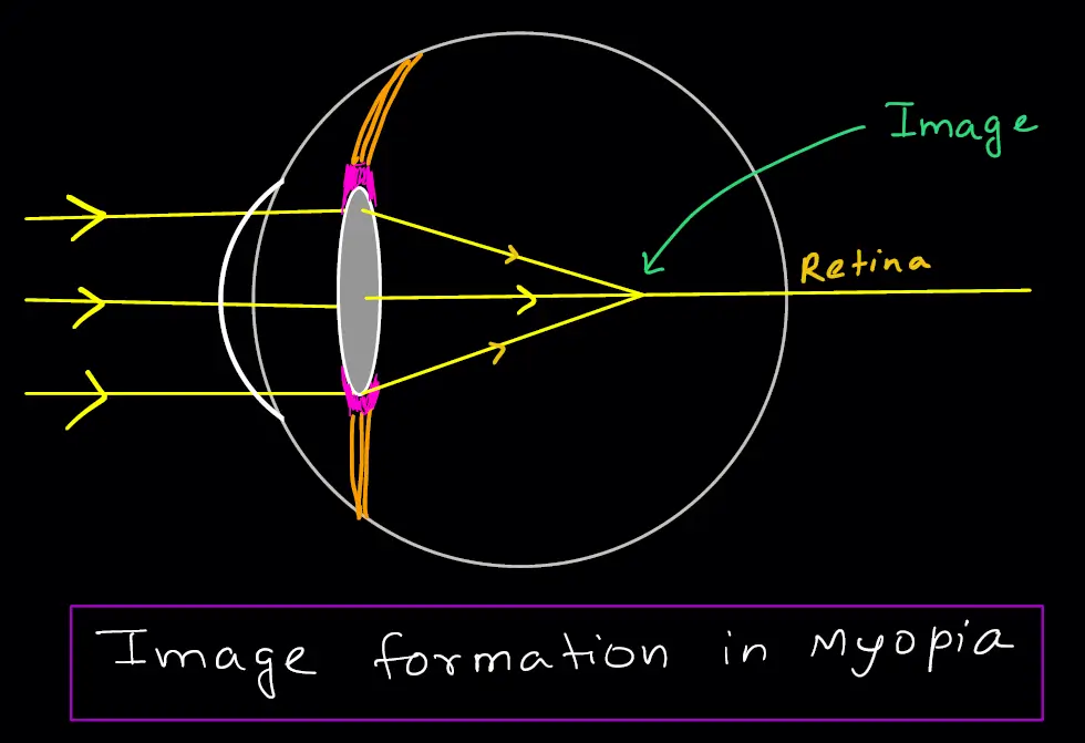 Image formation in myopia