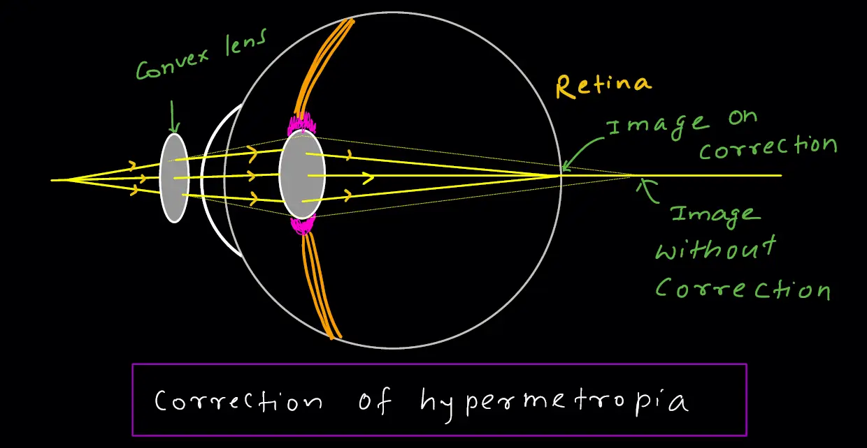 defects of vision - correction of hypermetropia